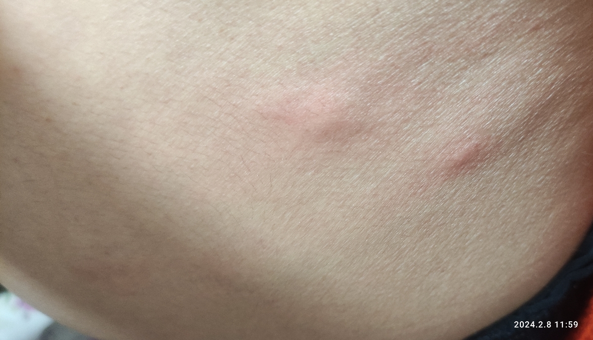 جوش های روی بدن در بارداری جوش های روی بدن در بارداری