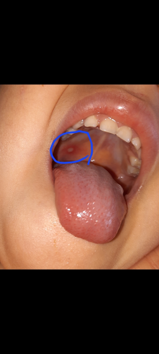 زخم گلو و تب کودک 3 ساله 😔