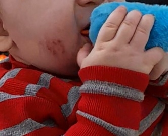 سلام خانم دکترعزیزخسته نباشیدصورت بچم چرااینجوری میشه.... سلام خانم دکترعزیزخسته نباشیدصورت بچم چرااینجوری میشه....