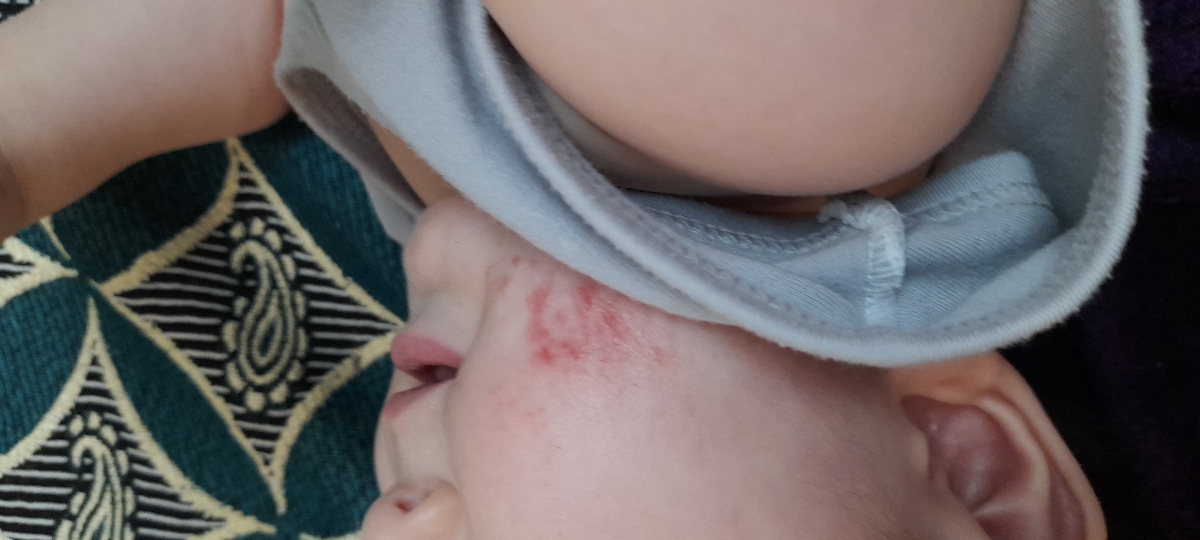 سلام خانم دکترعزیزخسته نباشیدصورت بچم چرااینجوری میشه.... سلام خانم دکترعزیزخسته نباشیدصورت بچم چرااینجوری میشه....