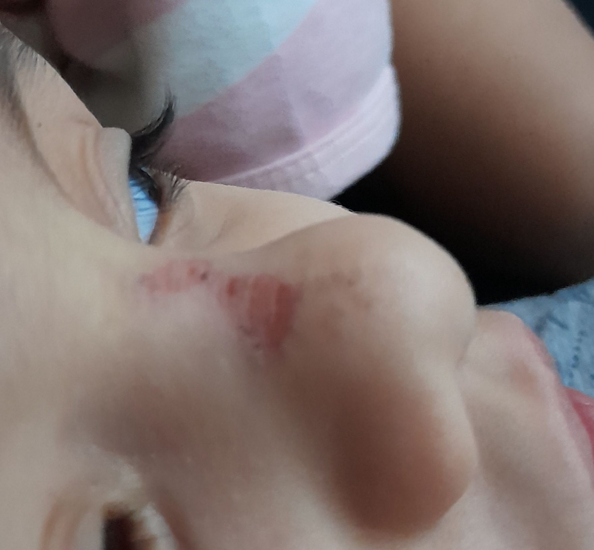 زخم صورت بچه و درمانش