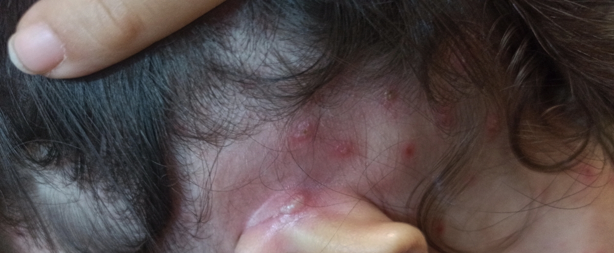 آبله مرغانه یا سرخک؟ آبله مرغانه یا سرخک؟