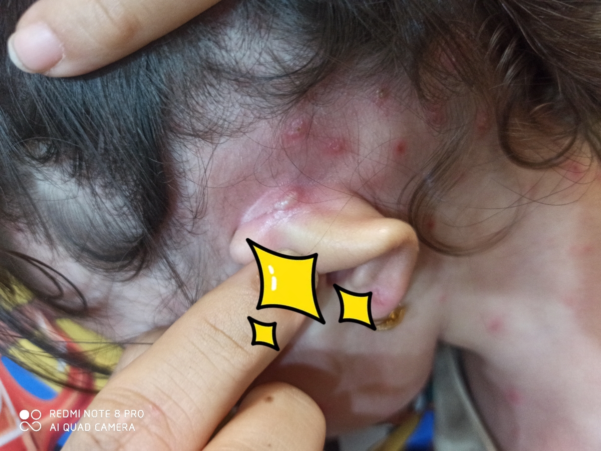آبله مرغانه یا سرخک؟ آبله مرغانه یا سرخک؟