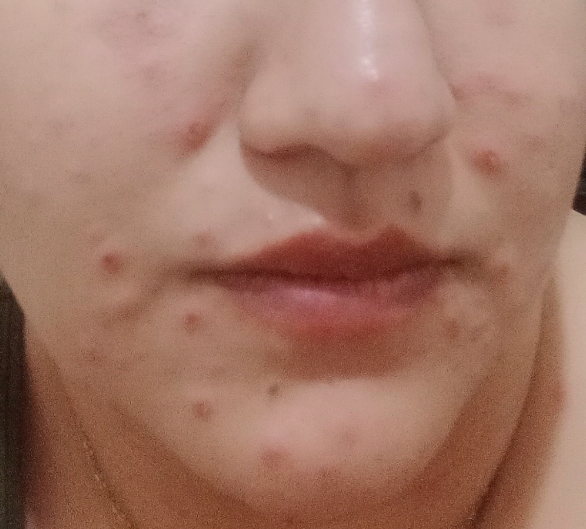 ابله مرغون جای زخم ابله مرغون جای زخم