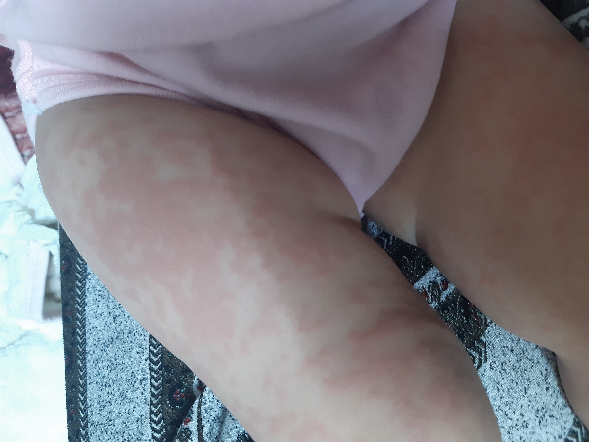 حساسیت کودک یکساله به توت سیاه؟