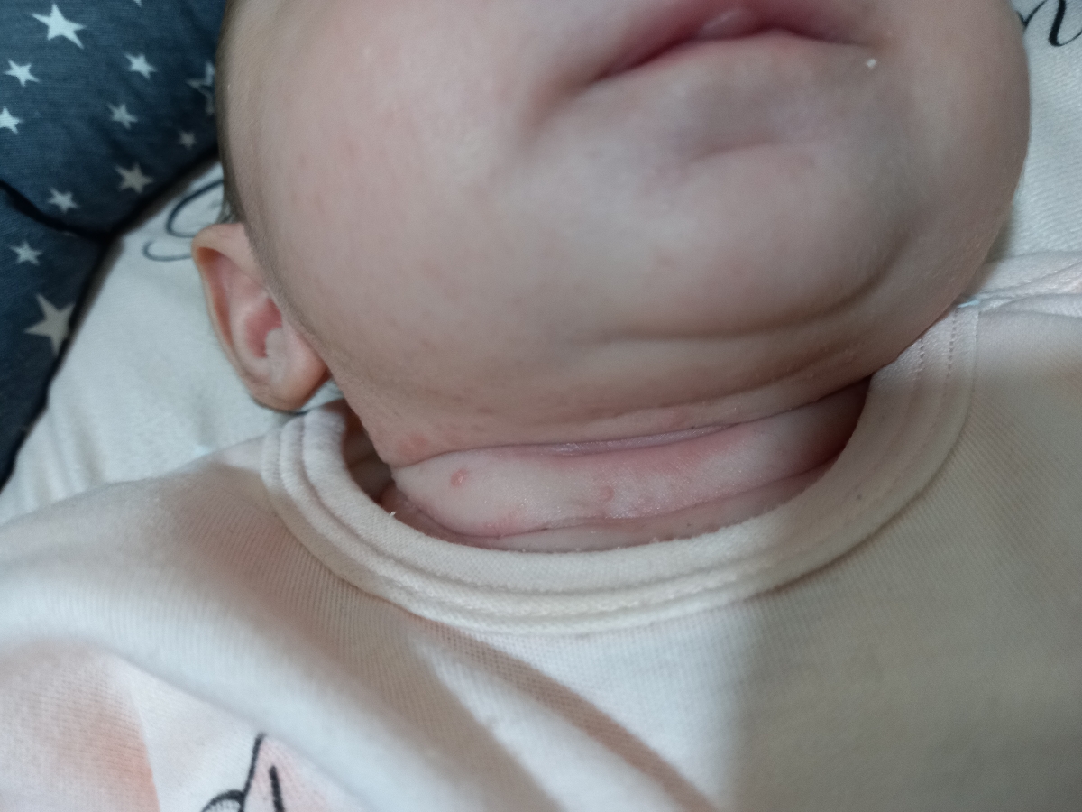 سوختگی و جوش زیر گردن
