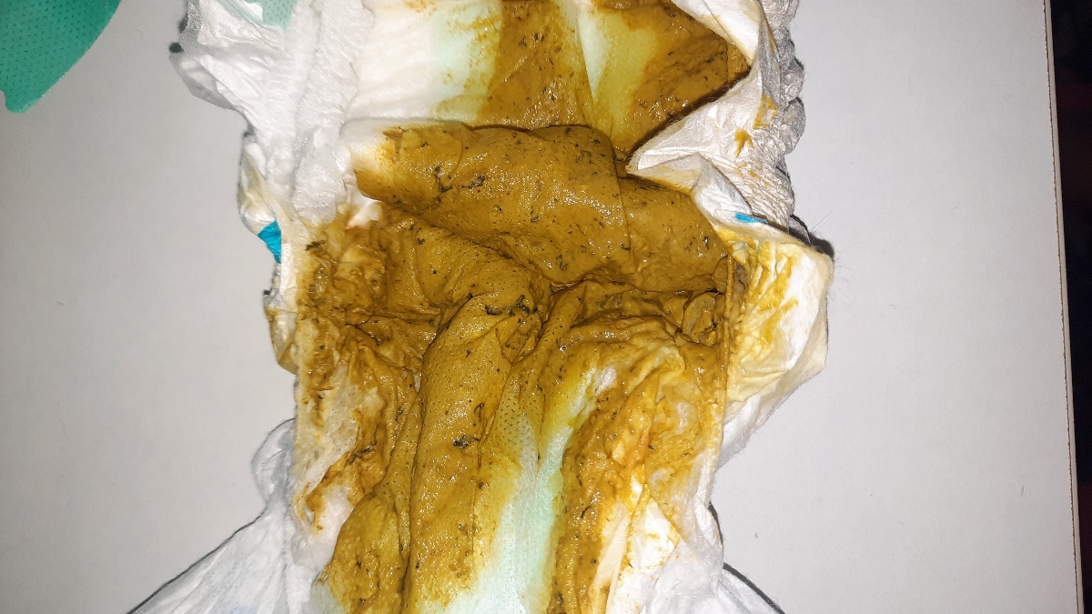 مدفوع نوزاد ۶ ماهه سوالم حاوی یه عکس اگه حالتون بد میشه نگاه نکنین