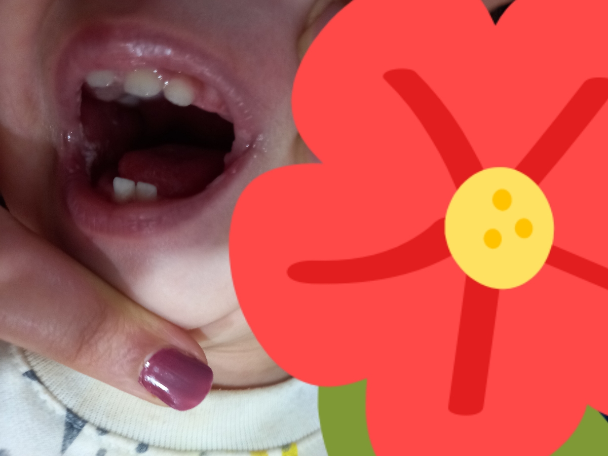 سلام دکتر محترم ایا این لکه های سفید تودهان کودکم برفکه؟