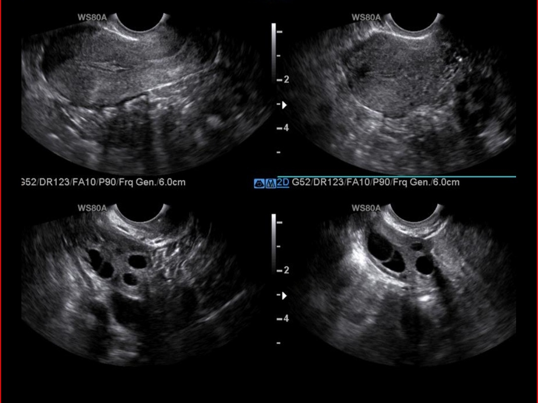 هیستروسونوگرافی روز۹ و فیبروم و آندومتر پایین