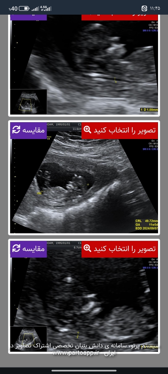 تعیین جنسیت با سونو ان تی تعیین جنسیت با سونو ان تی