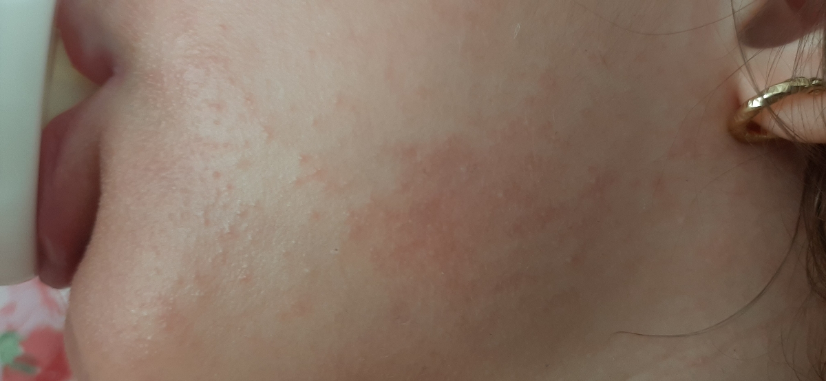 عوارض واکسن بعد از ۱۸ روز