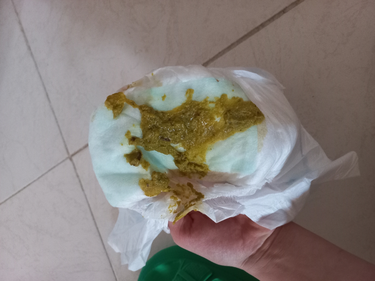 ❌️خلط خونی در مدفوع نوزاد❌️ ❌️خلط خونی در مدفوع نوزاد❌️