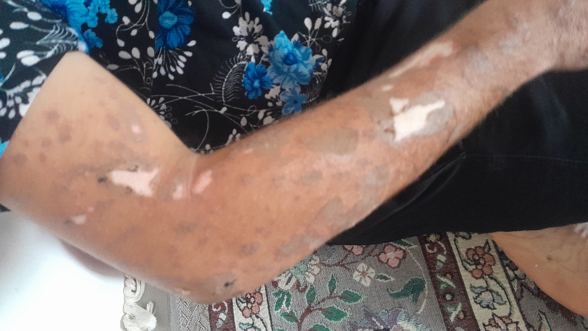 سوختگی با قیر داغ سوختگی با قیر داغ