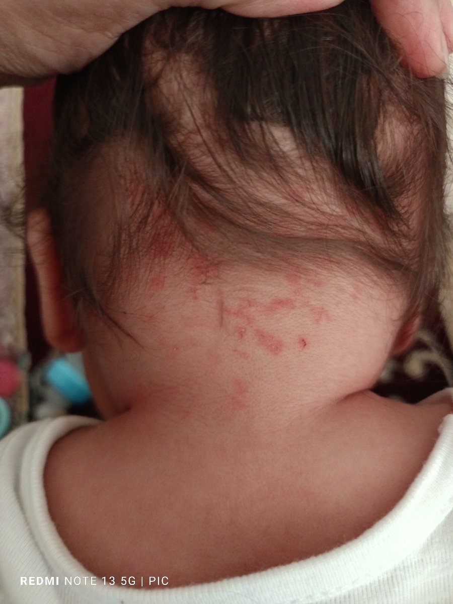 واکسن ۶ماهگی وعوارض ان واکسن ۶ماهگی وعوارض ان