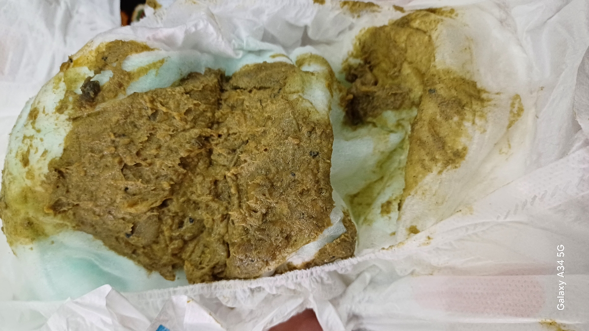 بررسی عکس دفع شیرخوار(حاوی عکس)