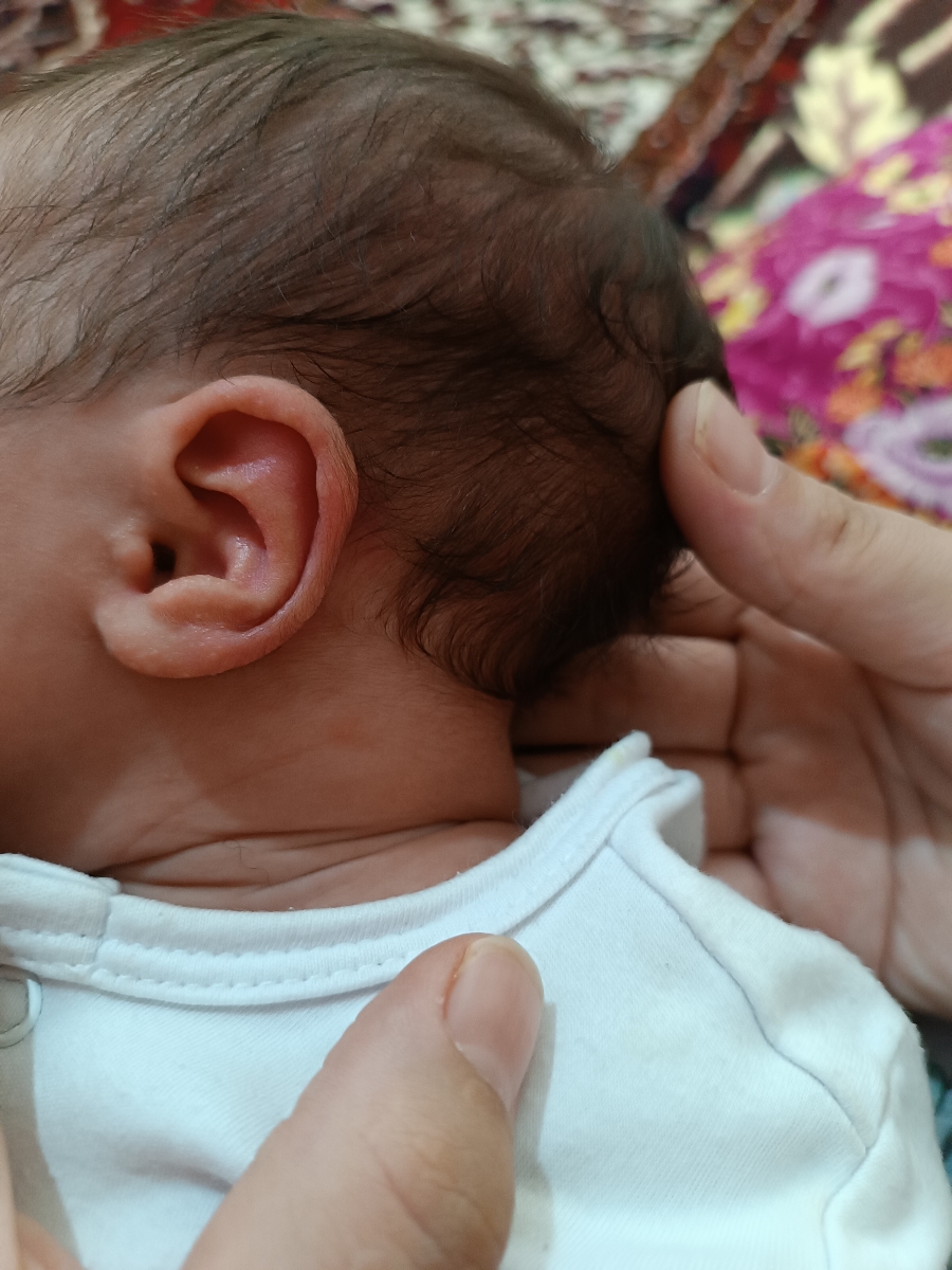 جوش ریز صورت و گوش جوش ریز صورت و گوش