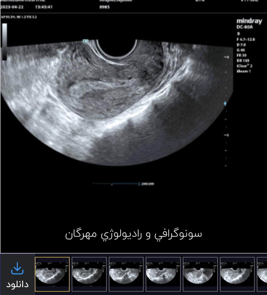 تفسیر سونوگرافی بقایا تفسیر سونوگرافی بقایا