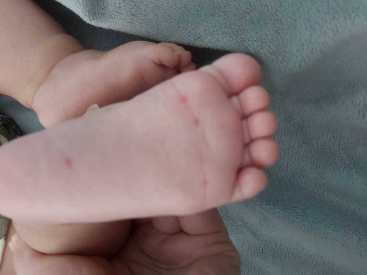 جای گزش پشه در نوزاد جای گزش پشه در نوزاد