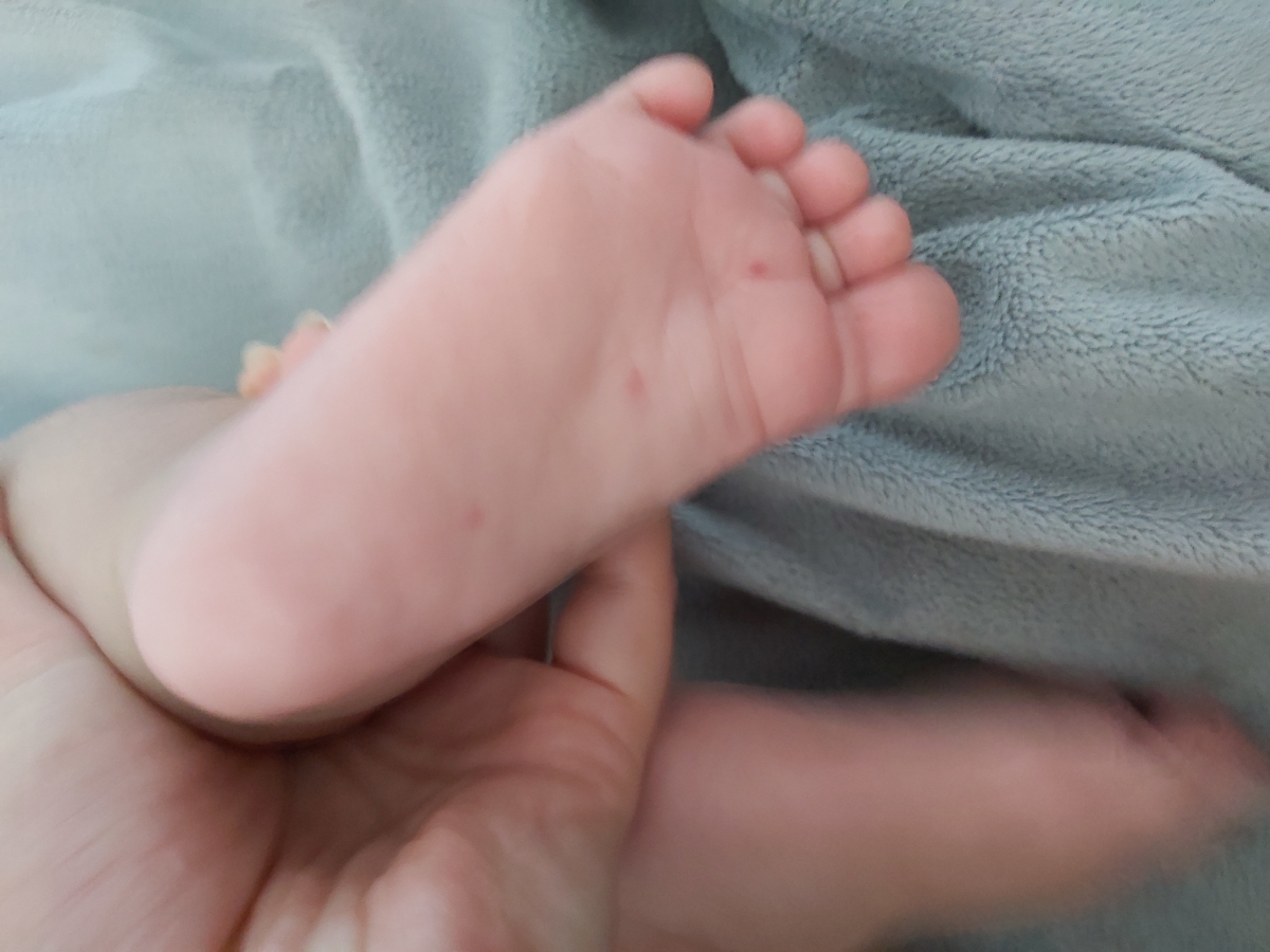 جای گزش پشه در نوزاد جای گزش پشه در نوزاد
