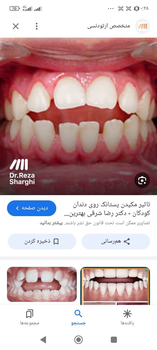 جلو امدن فک بالا بخاطر استفاده از پستونک جلو امدن فک بالا بخاطر استفاده از پستونک