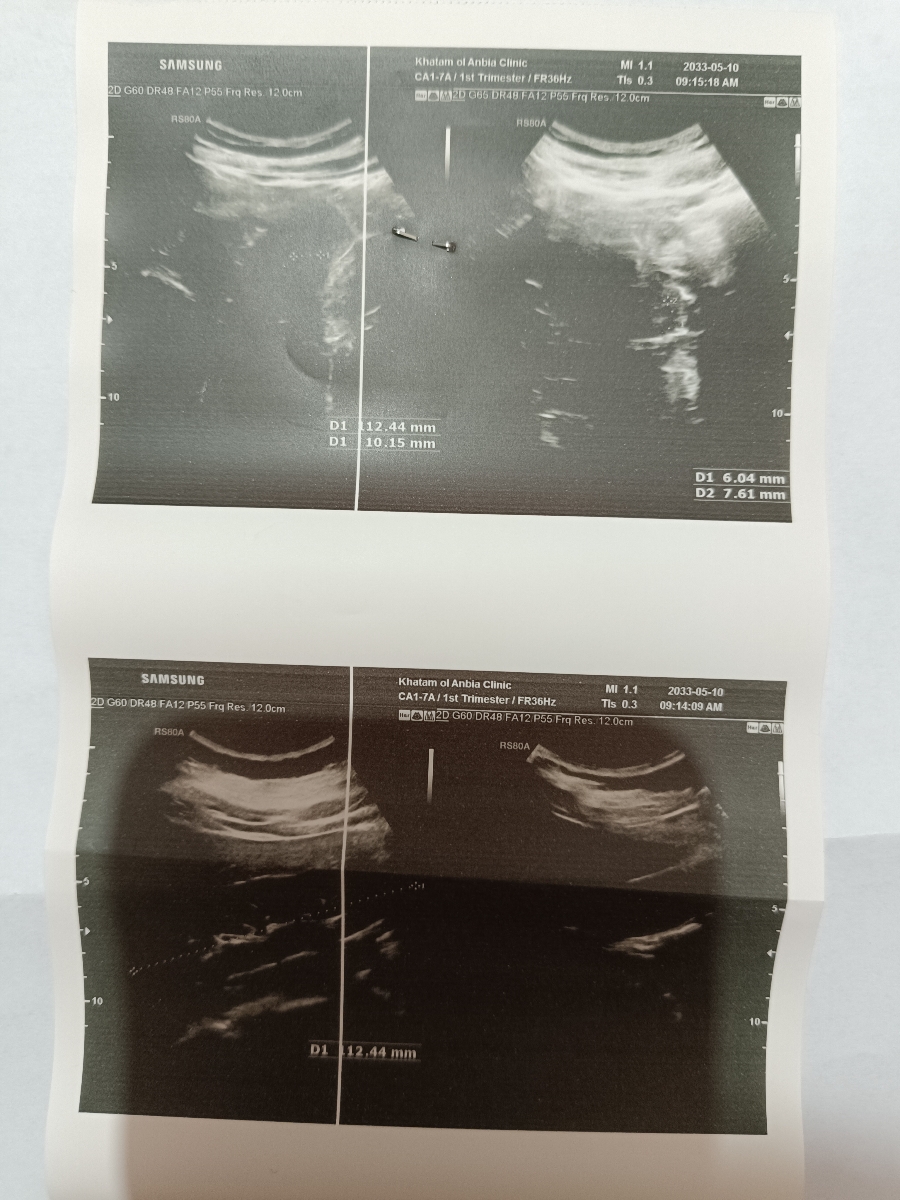 تفسیر سونوگرافی شکم و لگن