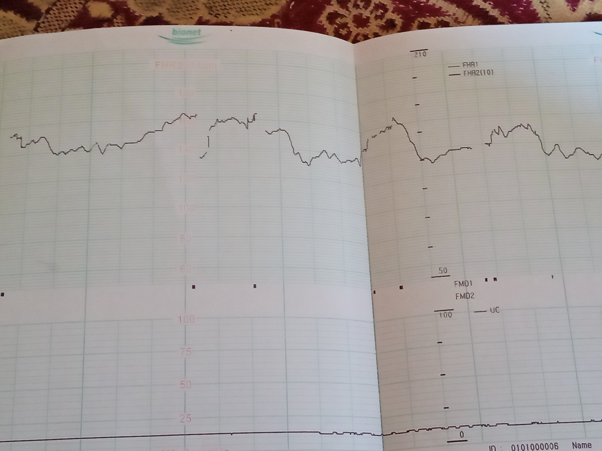 بررسی نوار قلب جنین