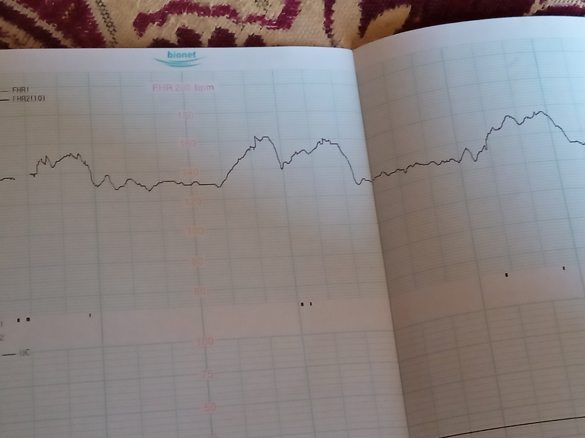 بررسی نوار قلب جنین