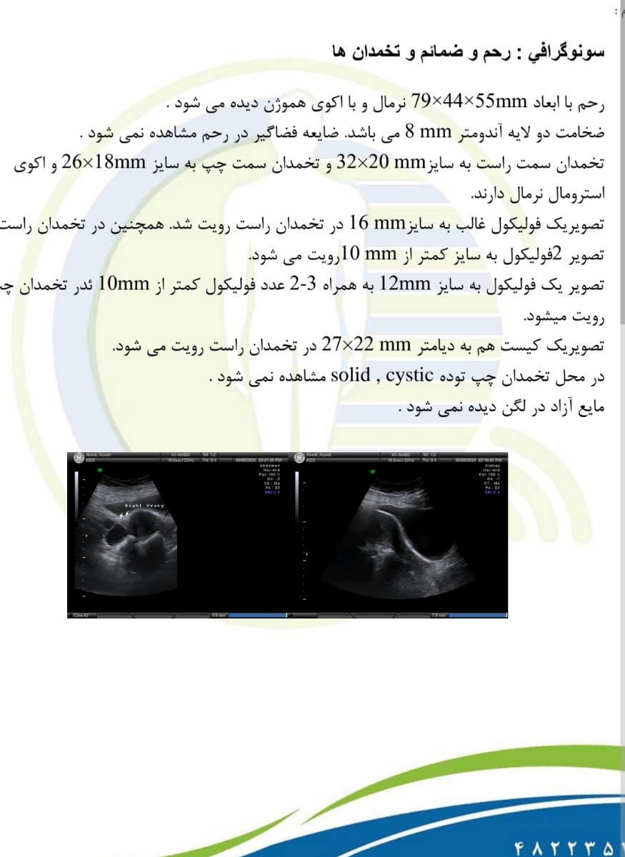 سونوگرافی فولبکول غالب در روز ۱۰ سیکل