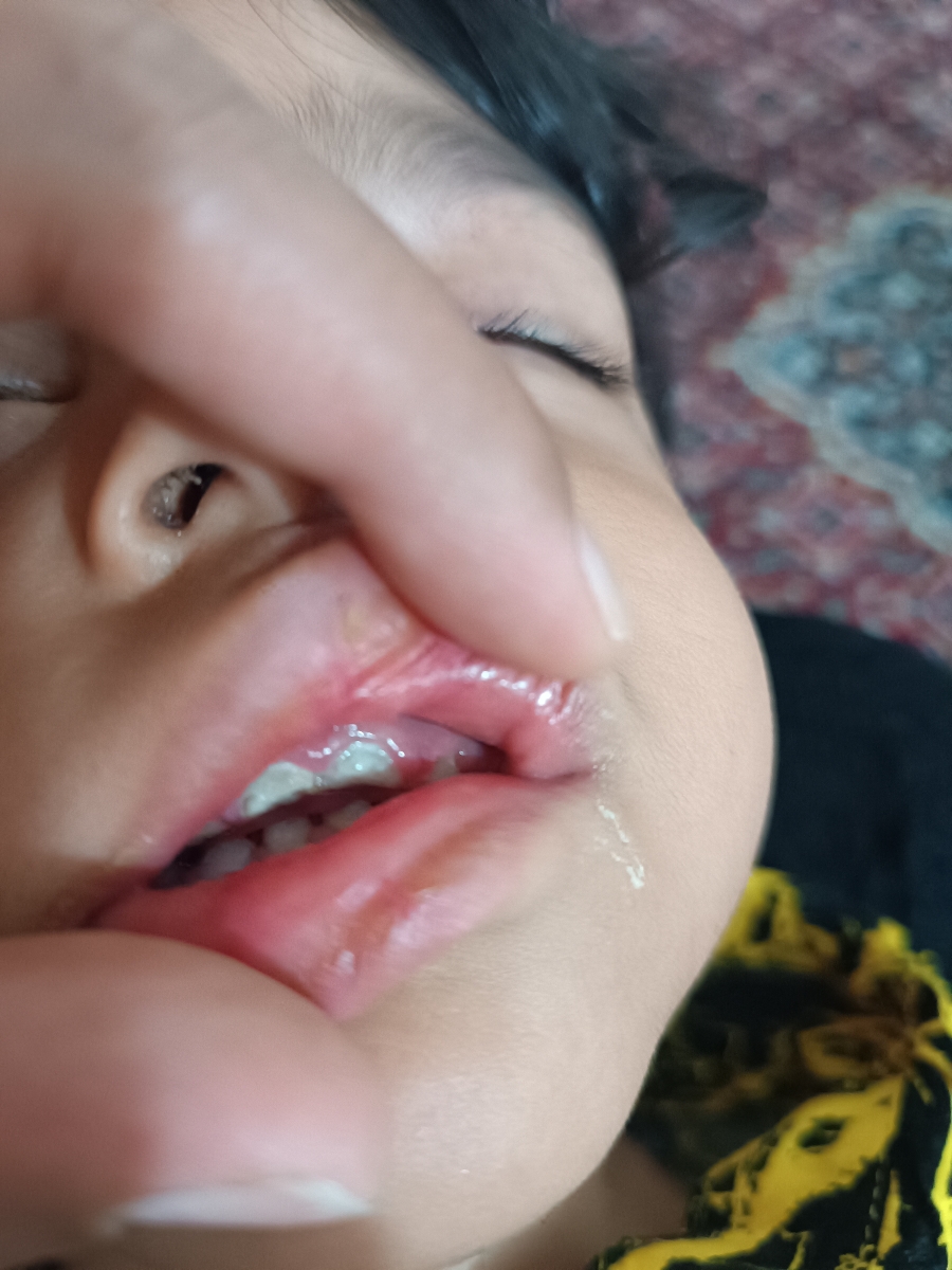 دکترجان ببخشید چرا همه دندان بالای پسرم اینجوری در اومده پایین مشکلی نداره فقط بالا این شکلی هستن