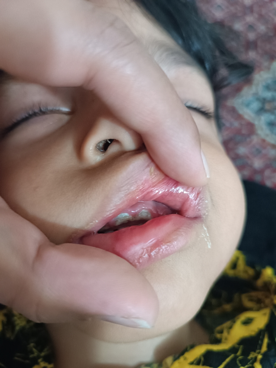 تب واسهال کودک ۲ساله