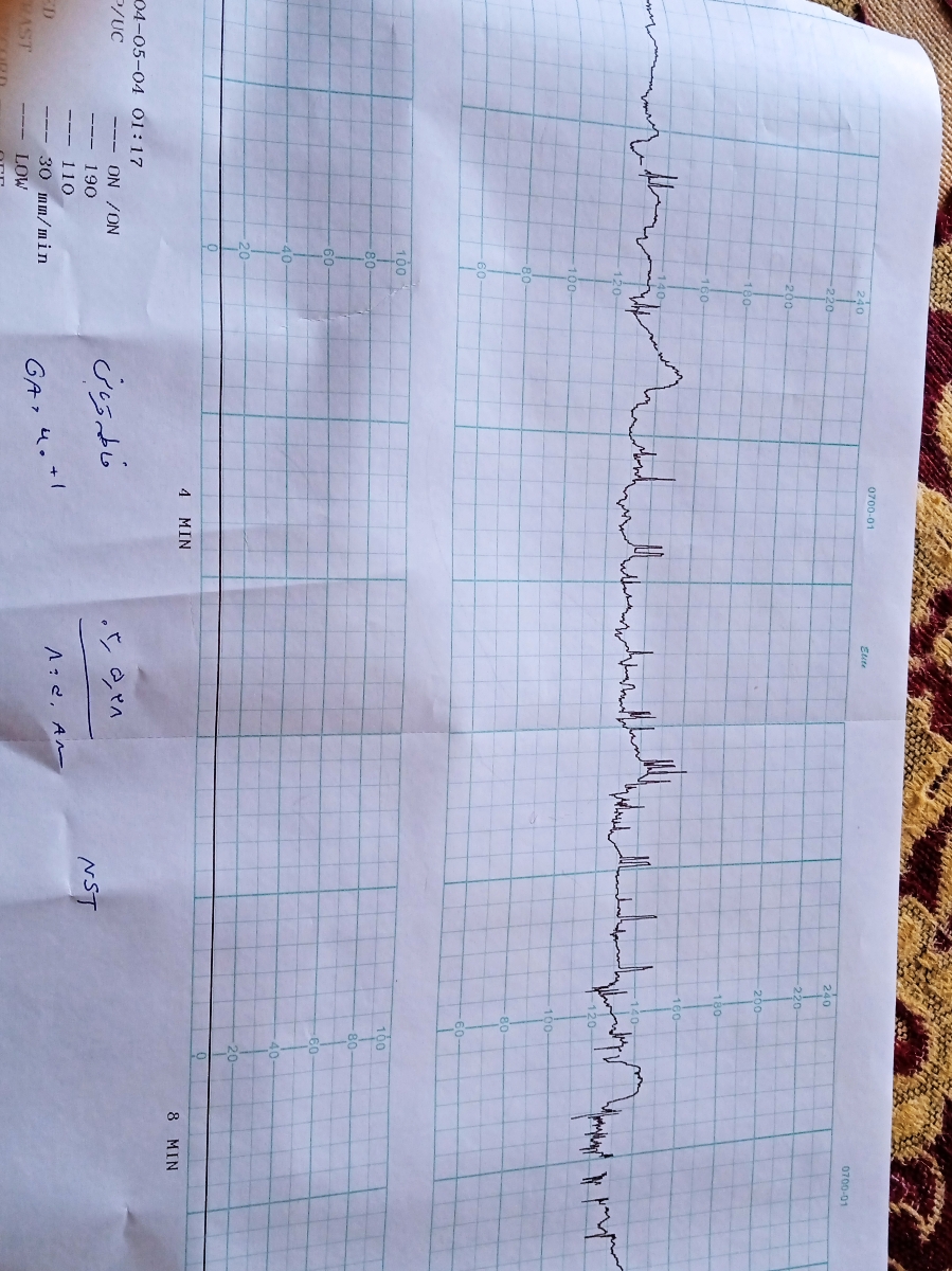 بررسی نوار قلب جنین