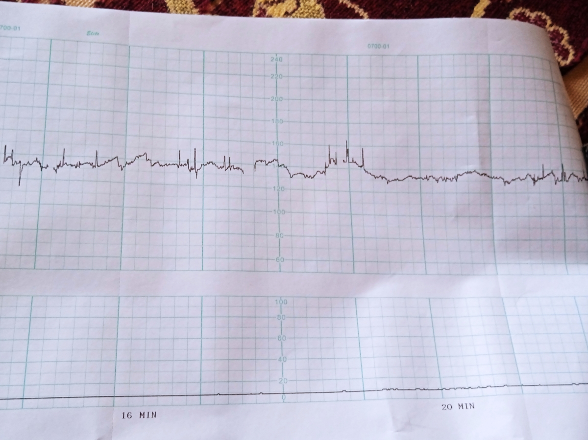 بررسی نوار قلب جنین