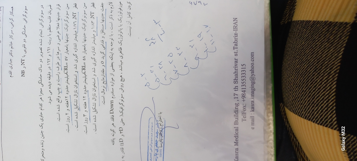ریسک سندروم داون در دوقلویی ریسک سندروم داون در دوقلویی