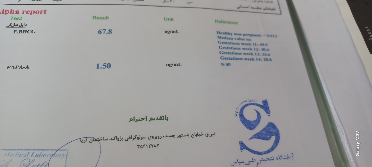 ریسک سندروم داون در دوقلویی ریسک سندروم داون در دوقلویی