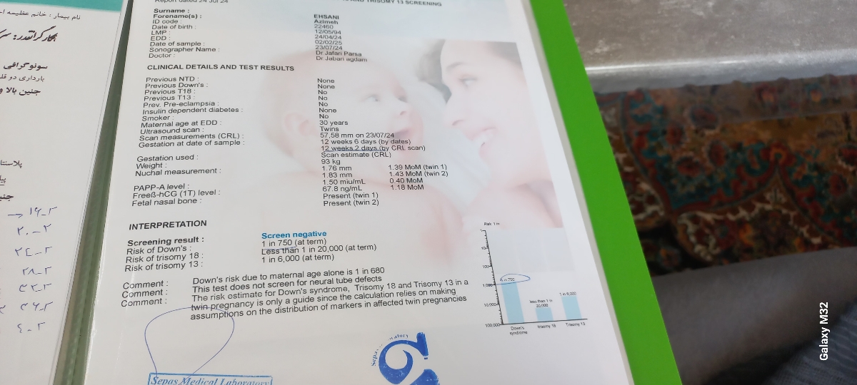 ریسک سندروم داون در دوقلویی ریسک سندروم داون در دوقلویی