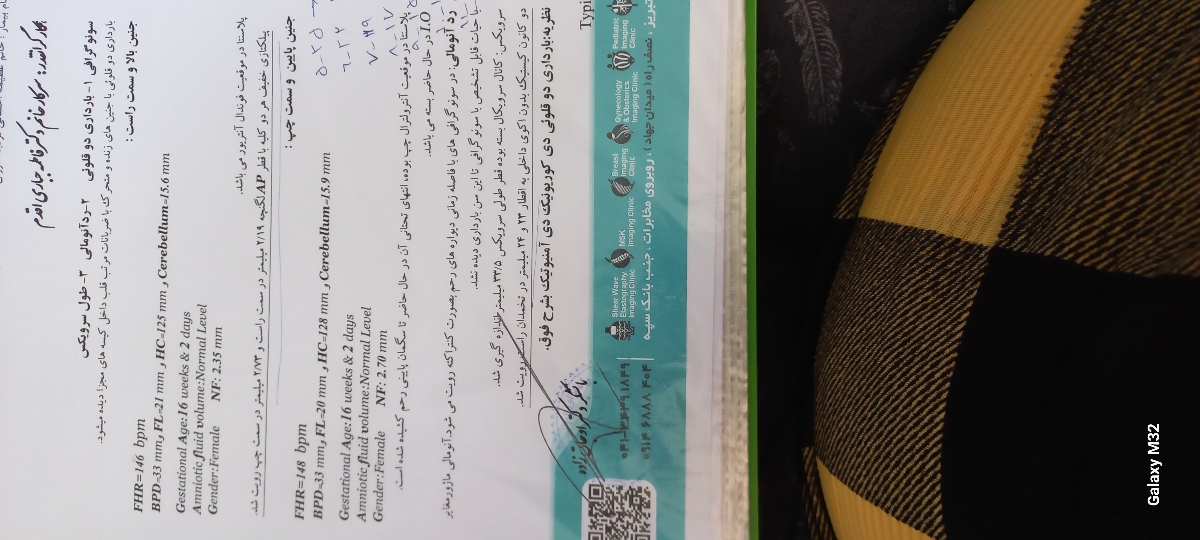 ریسک سندروم داون در دوقلویی ریسک سندروم داون در دوقلویی