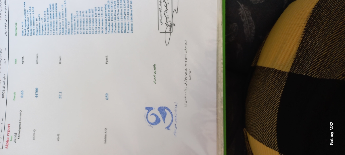 ریسک سندروم داون در دوقلویی ریسک سندروم داون در دوقلویی