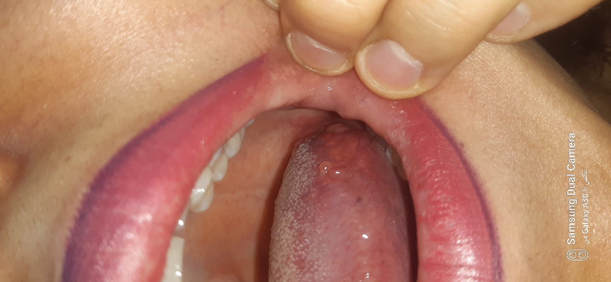 علت دونه زدن سمت چپ زبان حالت تبخالی