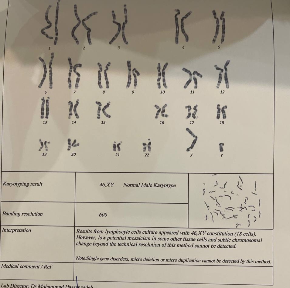 کاریوتایپ هم بررسی کنین ممنون