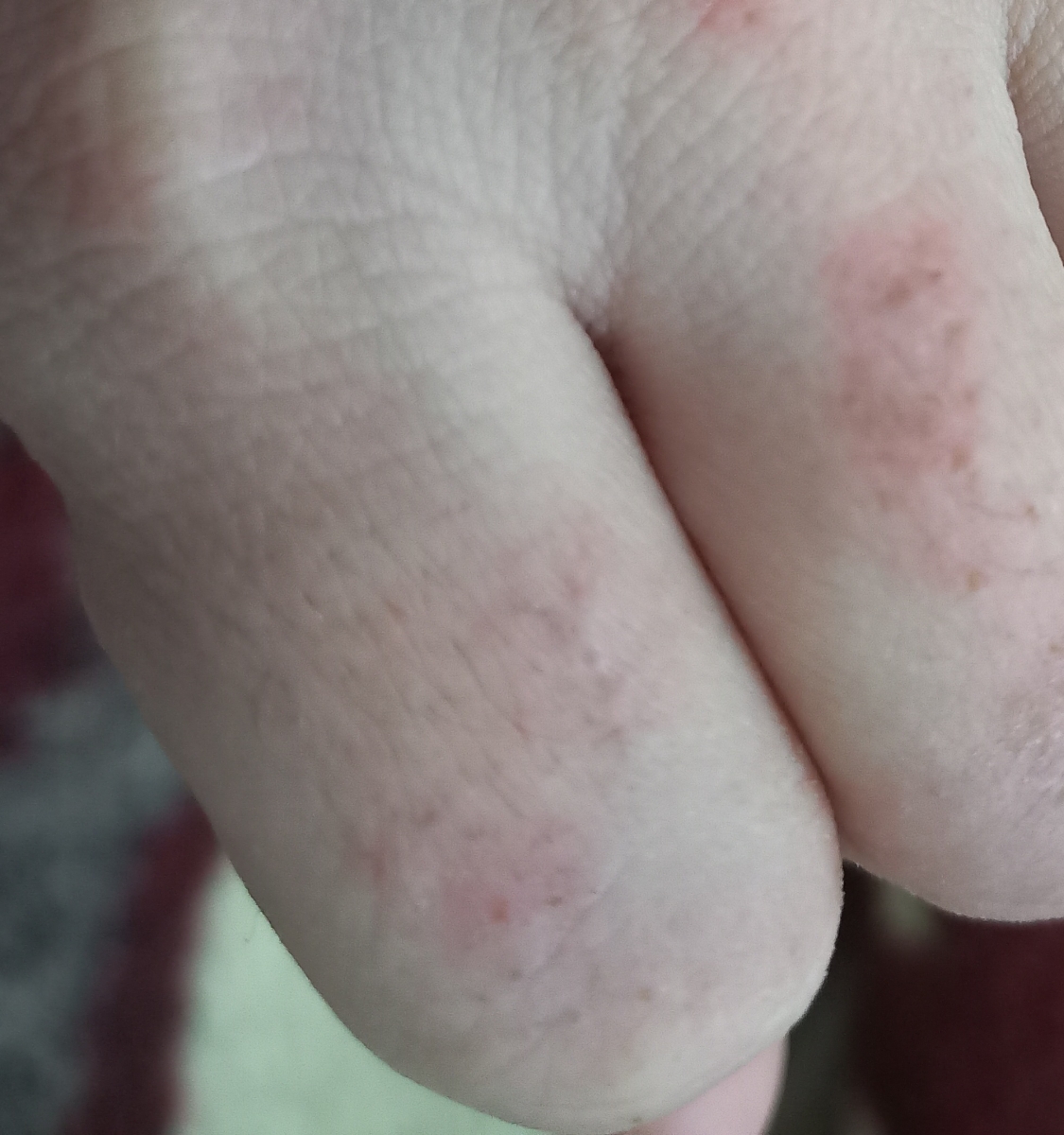 کهیر و قرمز شدن پوست