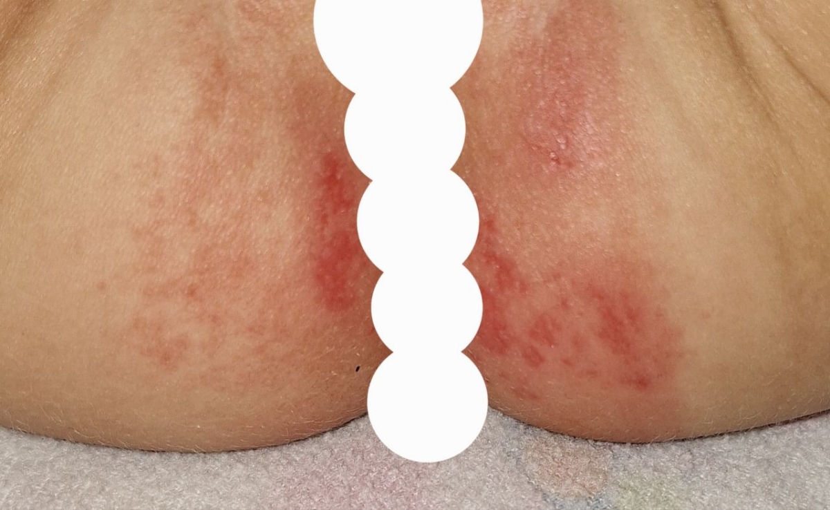 ادرار سوختگی و لک،پای کودک ۱۸ ماهه ادرار سوختگی و لک،پای کودک ۱۸ ماهه