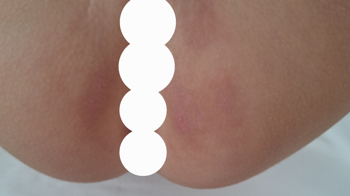 ادرار سوختگی و لک،پای کودک ۱۸ ماهه ادرار سوختگی و لک،پای کودک ۱۸ ماهه