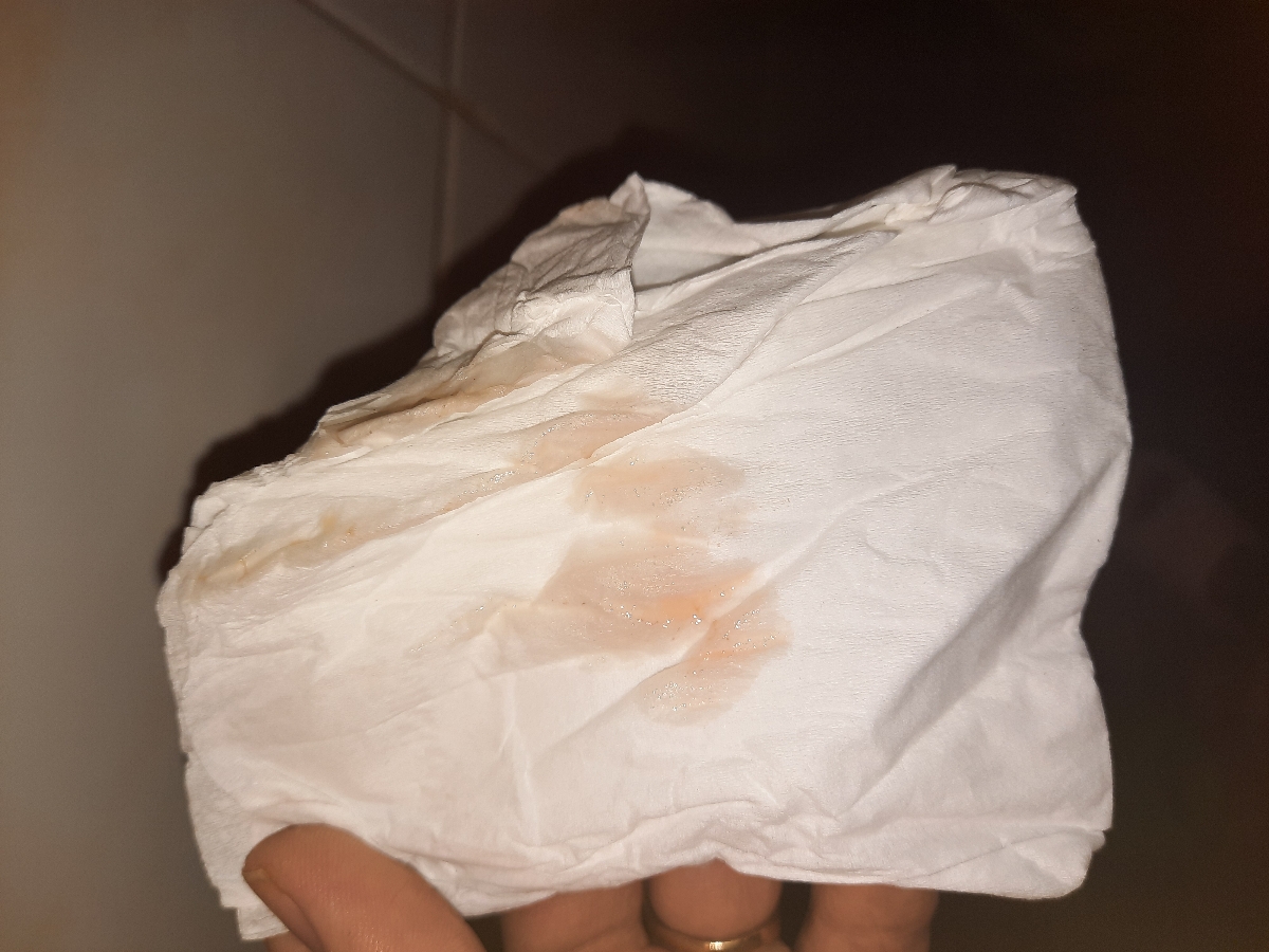 خونابه بعد از سرکلاژ در هفته ۲۰