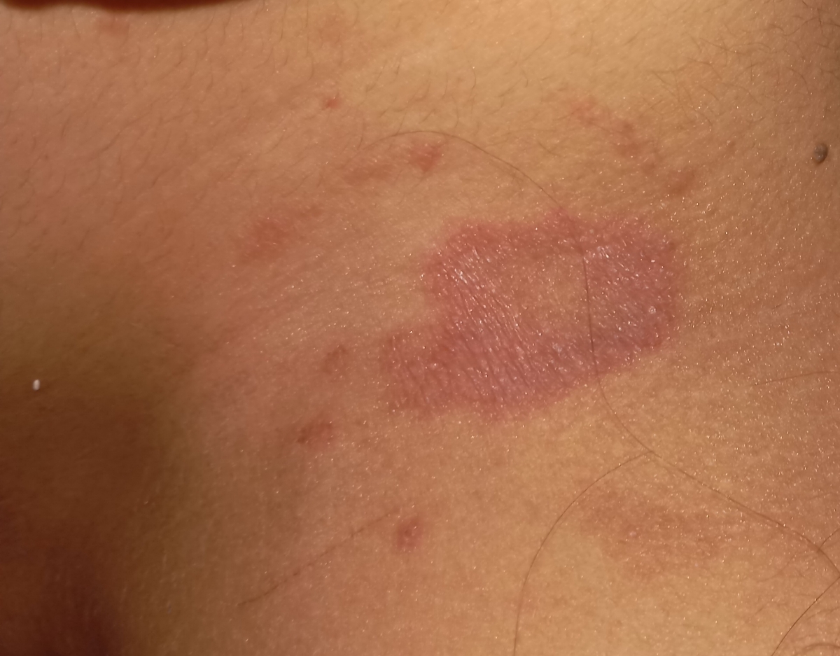 اگزما پوستی در بارداری