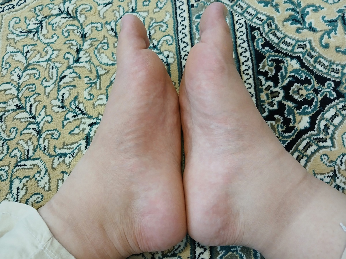 ورم پا در بارداری ورم پا در بارداری