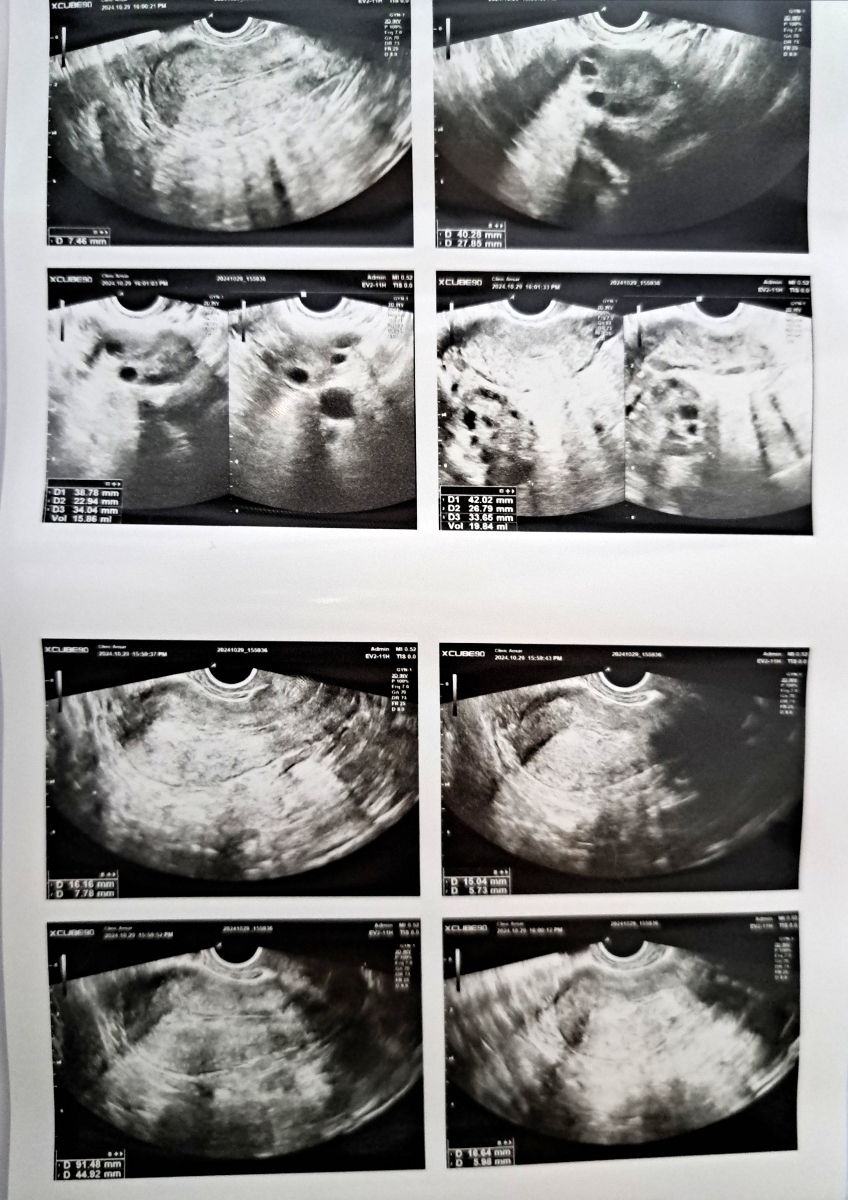 بررسی سونو واژینال و سونو سینه به همراه آزمایش هورمونی