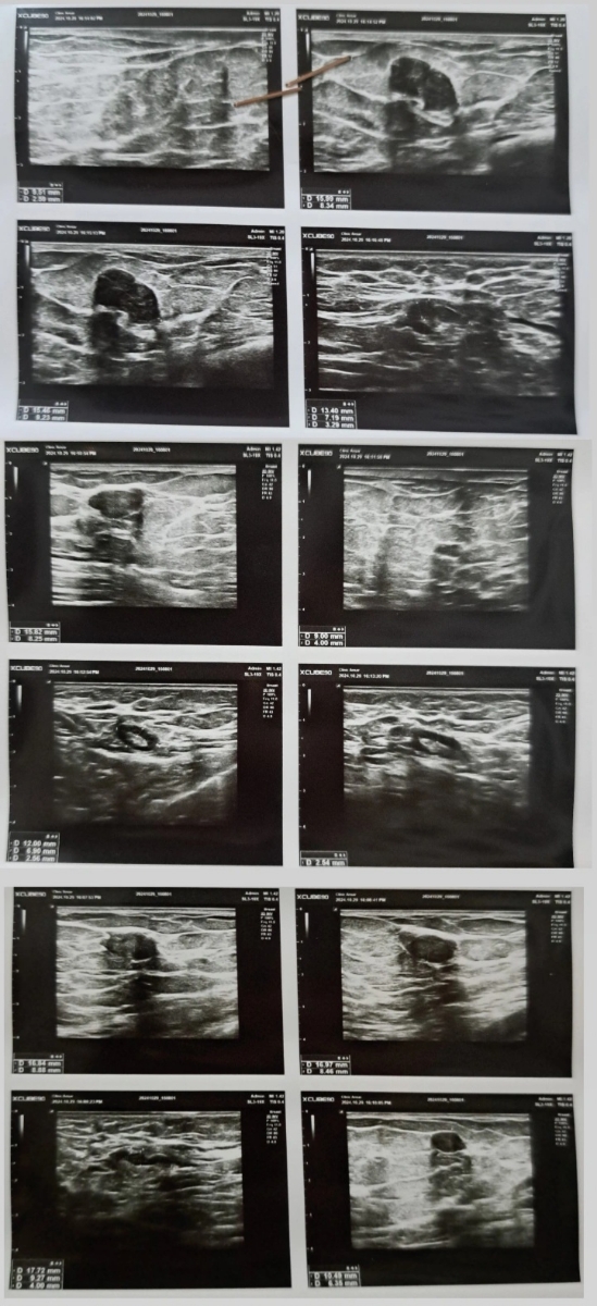 بررسی سونو واژینال و سونو سینه به همراه آزمایش هورمونی