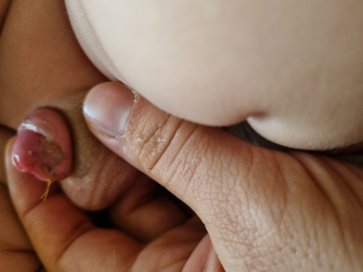 ختنه ب روش لیزر و بخیه عکس ختنه ب روش لیزر و بخیه عکس