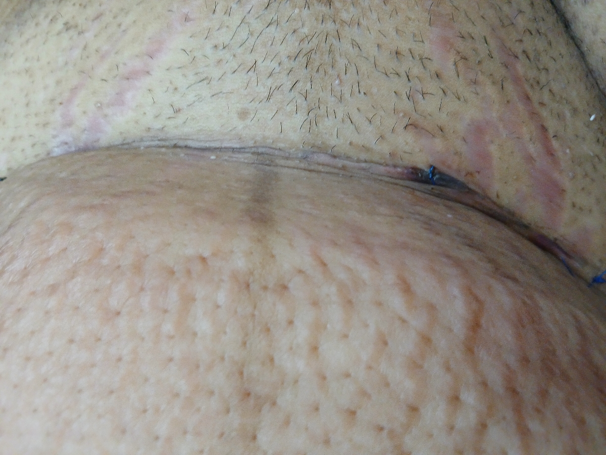 زخم بخیه آیا نرمال هست؟