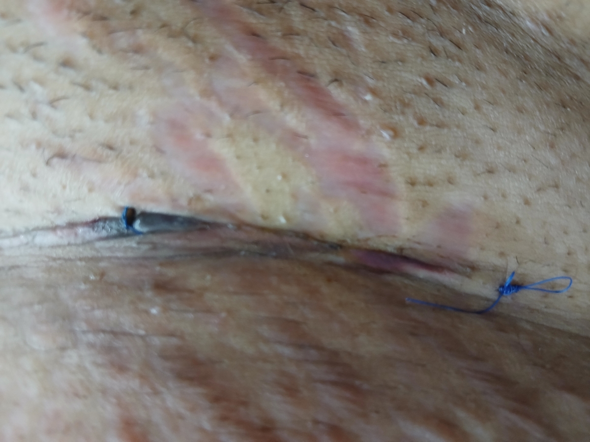 زخم بخیه آیا نرمال هست؟